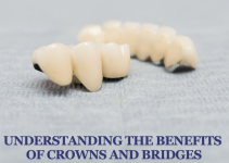 Understanding the Benefits of Crowns and Bridges