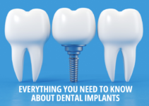 Everything You Need To Know About Dental Implants